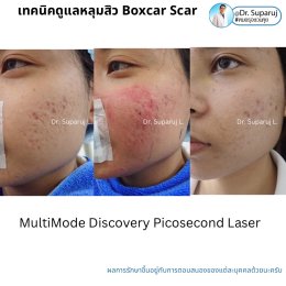Update รักษาหลุมสิวด้วยเทคนิคการตัดพังผืด Blunt Blade Subcision (Blunt Blade Subcision for Acne Scar Fibrosis Treatment)