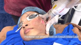 Update เทคนิครักษาหลุมสิว ด้วยการใช้สองพลังงานเสริมประสิทธิภาพร่วมกัน: Secret DUO Fractional RF Microneedle + Fractional ErGlasss Laser