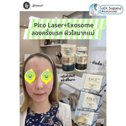 รีวิวรักษาหลุมสิวด้วย Pico Laser +Exosome มันเริดมากแม๊