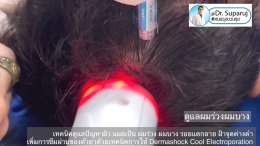 เทคนิคดูแลปัญหาผิว แผลเป็น ผมร่วง ผมบาง รอยแตกลาย ฝ้าจุดด่างดำ เพิ่มการซึมผ่านของตัวยาด้วยเทคนิคการใช้ Dermashock Cool Electroporation