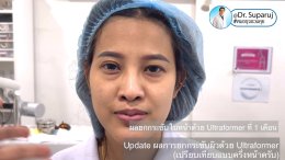 Update ผลการยกกระชับผิวด้วย Ultraformer III (เปรียบเทียบแบบครึ่งหน้าให้เห็นชัดๆครับ)
