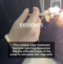 แนะนำเทคนิคดูแลปัญหาผมร่วงผมบาง: Exosome เอ็กโซโซม ช่วยดูแลผมร่วงผมบางได้อย่างไร?