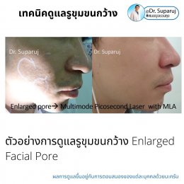เทคนิควิเคราะห์ & รักษาขุมขนกว้าง Enlarged Facial Pore ด้วยกล้อส่องขยายพิเศษทางผิวหนัง Dermoscopy