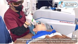 Update Discovery Picosecond Laser จุดเด่น & หลักการทำงาน ใช้ดูแลหลุมสิว แผลเป็น รอยแตกลาย ฝ้า กระจุดด่างดำ ได้อย่างไร ? 