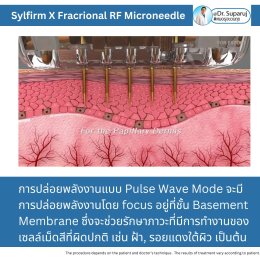 "แนะนำเทคนิคดูแลผิวหลังรักษาหลุมสิวด้วยเลเซอร์ครับIntroducing Techniques for Caring for and Treating Acne Scars with Laser"