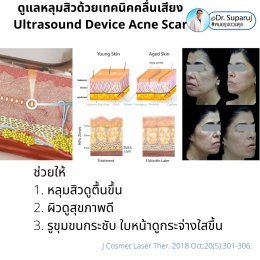 เทคโนโลยียกกระชับผิว MMFU : Micro &Macro Focused Ultrasound ของ Ultraformer III ทำงานอย่างไร ทำไมถึงดีกว่า HIFU ?