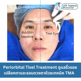 แนะนำเทคนิครักษาหลุมสิวและสิวอักเสบ: ประเมินชนิดความรุนแรงหลุมสิว + เทคโนโลยี Tixel ทิกเซล+ Exosomes
