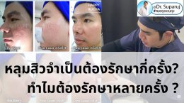 หลุมสิวจำเป็นต้องรักษากี่ครั้ง? ทำไมต้องรักษาหลายครั้ง ?