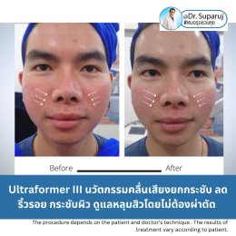 Update ผลการยกกระชับผิวด้วย Ultraformer III (เปรียบเทียบแบบครึ่งหน้าให้เห็นชัดๆครับ)