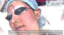 Q:Picosecond Laser หลุมสิวต้องยิงให้เลือดสาดไหม?