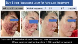 "แนะนำเทคนิคดูแลผิวหลังรักษาหลุมสิวด้วยเลเซอร์ครับIntroducing Techniques for Caring for and Treating Acne Scars with Laser"
