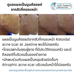  แนะนำเทคนิคดูแลแผลเป็นนูนคีลอยด์จากสิวที่กรอบหน้า MultiLaser Therapy and Injection Technique to Treat Keloid Acne Scar on Jawline