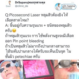 Update รักษาหลุมสิวด้วยเทคนิคการตัดพังผืด Blunt Blade Subcision (Blunt Blade Subcision for Acne Scar Fibrosis Treatment)