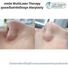 แนะนำเทคนิคดูแลแผลเป็นจากการผ่าตัด: ดูแลแผลเป็นนูนจากการผ่าตัดปีกจมูก Alarplasty ด้วยเทคนิค MultiLaser Therapy: Picosecond Laser + Gold Toning + Fractional Laser + Injection