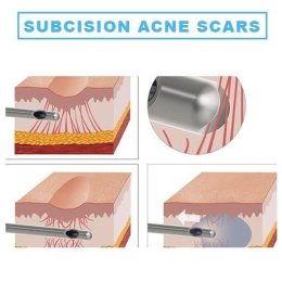 Update รักษาหลุมสิวด้วยเทคนิคการตัดพังผืด Blunt Blade Subcision (Blunt Blade Subcision for Acne Scar Fibrosis Treatment)