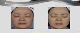 แนะนำนวัตกรรม SYLFIRM X Fractional Radiofrequency Microneedle ช่วยดูแลหลุมสิว ฝ้าเส้นเลือด ริ้วรอย ตัวช่วยปัญหาผิวจากประเทศสหรัฐอเมริกา