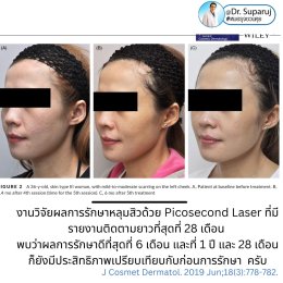 Q: หลังรักษาหลุมสิวด้วยเลเซอร์หรือเทคนิคต่างๆ หลังจากรักษาเรียบร้อยแล้ว จะมีโอกาสกลับมายุบตัว หรือหลุมสิวจะกลับมาแบบเดิมไหม?