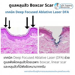 แนะนำเทคนิคดูแลหลุมสิว: เทคนิค Deep Focused Ablative Laser (DFA) ดูแลหลุมสิวลึกขอบชัดพังผืดหนา Boxcar Scar และหลุมสิวลักษณะเส้นยาว Linear scar