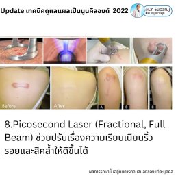 Update เทคนิคดูแลแผลเป็นนูนคีลอยด์ 2022