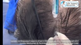 Update เทคนิค (เสริม)ดูแลผมร่วงผมบางจากพันธุกรรม AGA