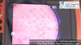 แนะนำเทคนิคดูแลรูขุมขนกว้าง: เทคนิคดูแลรูขุมขนกว้างด้วย Deep Carbon Peel Picosecond Laser (เทคนิคการใช้ Picosecond Laser พิโค่เลเซอร์ ร่วมกับผง carbon กระตุ้นการสร้างคอลลาเจนดูแลรูขุมขนกว้าง )