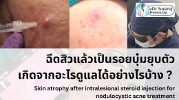 ฉีดสิวแล้วเป็นรอยบุ๋มยุบตัว เกิดจากอะไรดูแลได้อย่างไรบ้าง ?  (Skin atrophy after intralesional steroid injection for nodulocystic acne treatment )