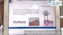Update เทคโนโลยีใหม่ เทคนิคการรักษาหลุมสิว เม็ดสี & จุดเด่นที่น่าสนใจของ Discovery PICO Laser Derm