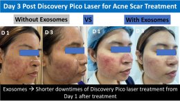 "แนะนำเทคนิคดูแลผิวหลังรักษาหลุมสิวด้วยเลเซอร์ครับIntroducing Techniques for Caring for and Treating Acne Scars with Laser"