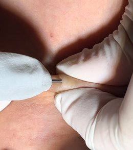 แนะนำเทคนิคดูแล ก้อนซีสต์จากท่อต่อมไขมัน Steatocystoma Multiplex (SM) ด้วย เข็มพลังงานคลื่นวิทยุ Insulated Radiofrequency RF Microneedle for Steatocystoma Multiplex Treatment