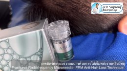 แนะนำเทคนิครักษาผมร่วงผมบาง: เทคนิครักษาผมร่วงผมบางด้วยการใช้เข็มพลังงานคลื่นวิทยุ Fractional Radiofrequency Microneedle FRM Anti-Hair Loss Technique