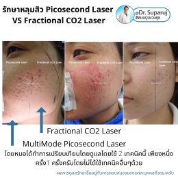 Update ผลการรักษาหลุมสิวด้วยเลเซอร์ Picosecond Laser VS Fractional CO2 Laser ต่างกันอย่างไร? เลเซอร์ชนิดไหนให้ผลดีกว่า?