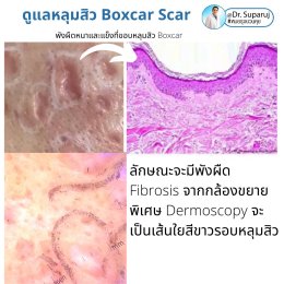 เทคนิคการดูแลหลุมสิว: ตัวอย่างการดูแลหลุมสิวแบบขอบชัดและแบบยุบตัวด้วยการใช้ Picosecond Laser + Perfusion Matrix Therapy