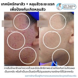 เป็นสิว + มีรอยดำจากสิว Acne dark spot ใช้ยา + สกินแคร์อะไร?จะได้ประโยชน์ดูแลทั้งสองอย่าง