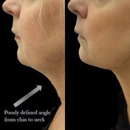 สาเหตุ & เทคนิคลดเหนียง ไขมันใต้คาง คาง 2 ชั้น Double Chin & Submental Fullness Treatment 
