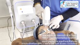 แนะนำเทคนิครักษาหลุมสิวและสิวอักเสบ: ประเมินชนิดความรุนแรงหลุมสิว + เทคโนโลยี Tixel ทิกเซล+ Exosomes
