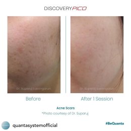 เทคนิคหลักการรักษาหลุมสิวด้วยเลเซอร์ Discovery Pico Laser ของหมอรุจได้รับการเผยแพร่ในระดับนานาชาติของทางบริษัทระดับโลก Quanta System จากประเทศอิตาลีครับ