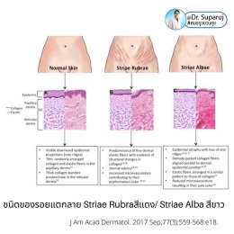 รักษาผิวแตกลายด้วยเทคนิคเลเซอร์ Double Laser Treatment : Picosecond Laser + Fractional Ablative Laser