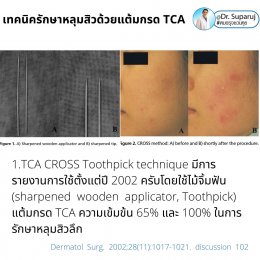 Update เทคนิครักษาหลุมสิวด้วยการแต้มกรด TCA: เทคนิคไม้จิ้มฟัน Toothpicks VS Syringe ไซริงค์ VS Painting CROSS TCA technique ต่างกันอย่างไร เทคนิคไหนดีที่สุด? https://youtu.be/CGeVtG64Elo