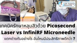 เทคนิครักษาหลุมสิวด้วย Picosecond Laser VS InfiniRF Microneedle แตกต่างกันอย่างไร อันไหนมีประสิทธิภาพดีกว่า ?