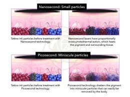 เทคนิคลบรอยสักด้วยเลเซอร์ Picosecond Laser มีจุดเด่นอย่างไร ?