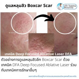 แนะนำเทคนิคดูแลหลุมสิว: เทคนิค Deep Focused Ablative Laser (DFA) ดูแลหลุมสิวลึกขอบชัดพังผืดหนา Boxcar Scar และ Linear scar