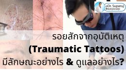 รอยสักจากอุบัติเหตุ (Traumatic Tattoos) มีลักษณะอย่างไร & ดูแลอย่างไร?