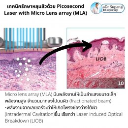 เทคนิครักษาหลุมสิวด้วย Picosecond Laser with Micro Lens array (MLA) มีกลไกล & จุดเด่นอย่างไร?