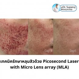 เทคนิครักษาหลุมสิวด้วย Picosecond Laser with Micro Lens array (MLA) มีกลไกล & จุดเด่นอย่างไร?