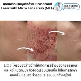 เทคนิครักษาหลุมสิวด้วย Picosecond Laser with Micro Lens array (MLA) มีกลไกล & จุดเด่นอย่างไร?