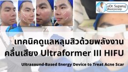เทคนิคดูแลหลุมสิวด้วยพลังงานคลื่นเสียง Ultraformer III HIFU (Ultrasound-Based Energy Device to Treat Acne Scar) 
