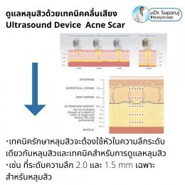 เทคนิคดูแลหลุมสิวด้วยพลังงานคลื่นเสียง Ultraformer III HIFU (Ultrasound-Based Energy Device to Treat Acne Scar) 