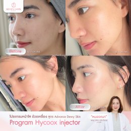 รีวิว Hycoox