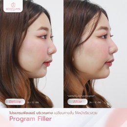 รีวิว Filler