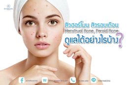 สิวฮอร์โมน สิวรอบเดือน Menstrual Acne, Peroid Acne ดูแลได้อย่างไรบ้าง?